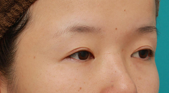 眼瞼下垂(がんけんかすい),眼球自体が小さく開きも悪い目に対して、目頭切開+眼瞼下垂手術で目を一回り大きくした症例写真,After(6ヶ月後),ba_megashira047_b02.jpg