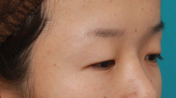 眼瞼下垂(がんけんかすい),眼球自体が小さく開きも悪い目に対して、目頭切開+眼瞼下垂手術で目を一回り大きくした症例写真,Before,ba_megashira047_b02.jpg