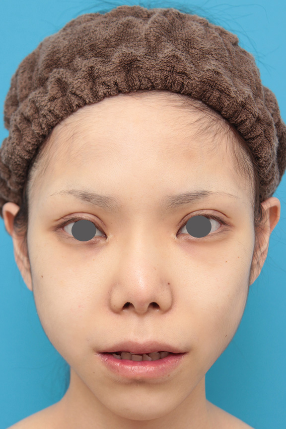 唇を薄く(口唇縮小術),上下の厚い唇を手術で程よく薄くした症例写真,After(8ヶ月後),ba_usuku007_b02.jpg
