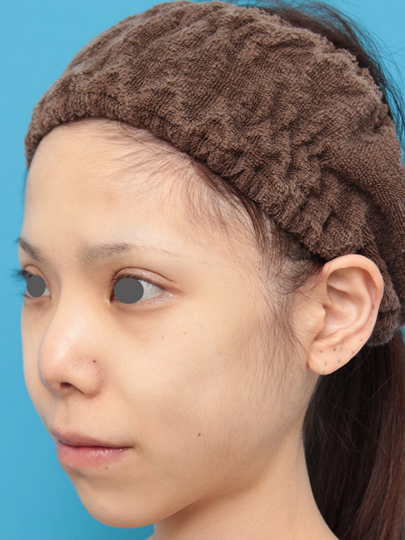 唇を薄く(口唇縮小術),上下の厚い唇を手術で程よく薄くした症例写真,After(8ヶ月後),ba_usuku007_b03.jpg