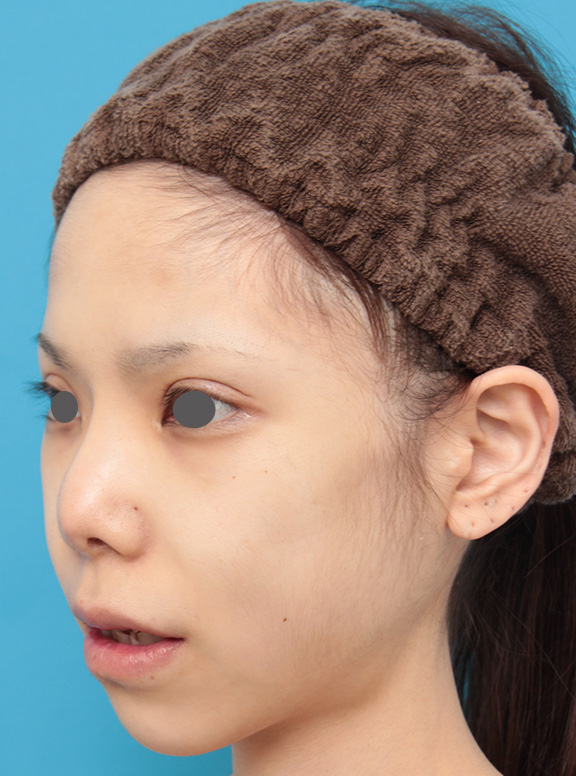 唇を薄く(口唇縮小術),上下の厚い唇を手術で程よく薄くした症例写真,After(8ヶ月後),ba_usuku007_b04.jpg