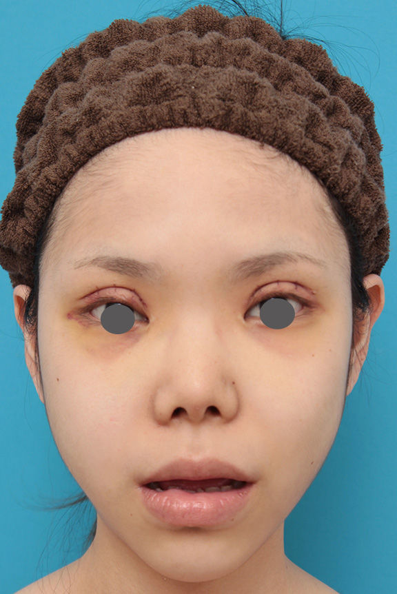 唇を薄く(口唇縮小術),上下の厚い唇を手術で程よく薄くした症例写真,Before,ba_usuku007_b02.jpg