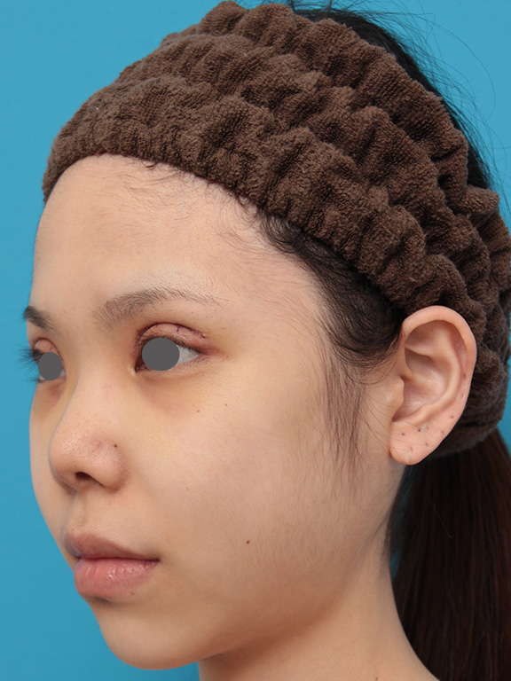 唇を薄く(口唇縮小術),上下の厚い唇を手術で程よく薄くした症例写真,Before,ba_usuku007_b03.jpg