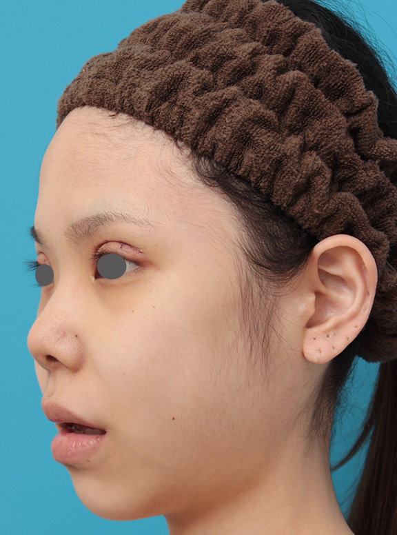 唇を薄く(口唇縮小術),上下の厚い唇を手術で程よく薄くした症例写真,Before,ba_usuku007_b04.jpg