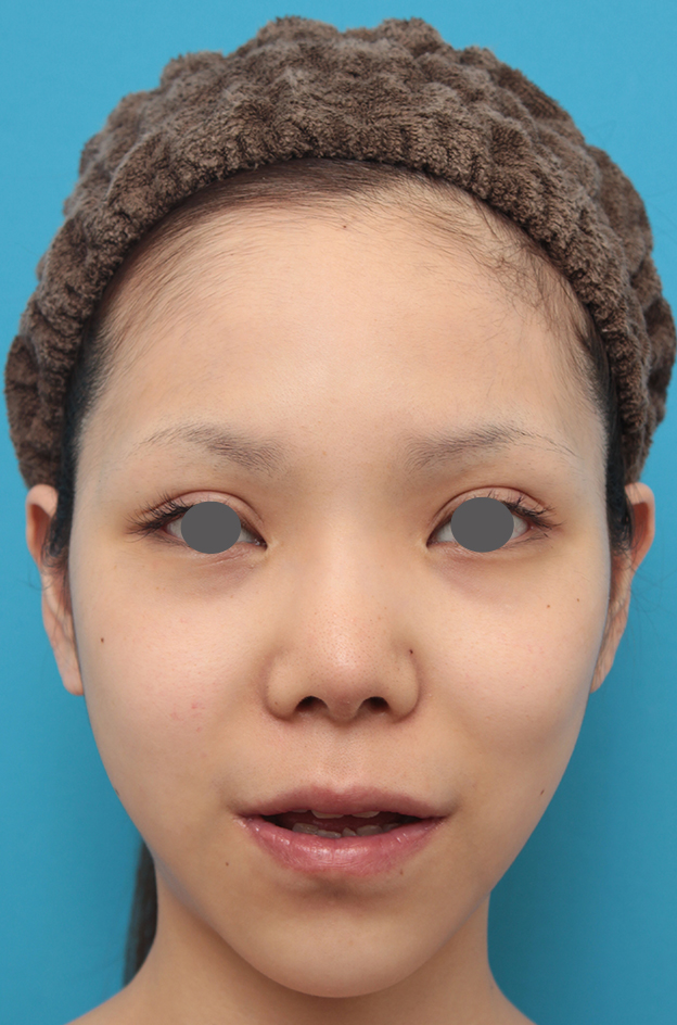 唇を薄く（口唇縮小術）,上下の厚い唇を手術で程よく薄くした症例写真,1ヶ月後,口を半開きにした状態,mainpic_usuku007g.jpg