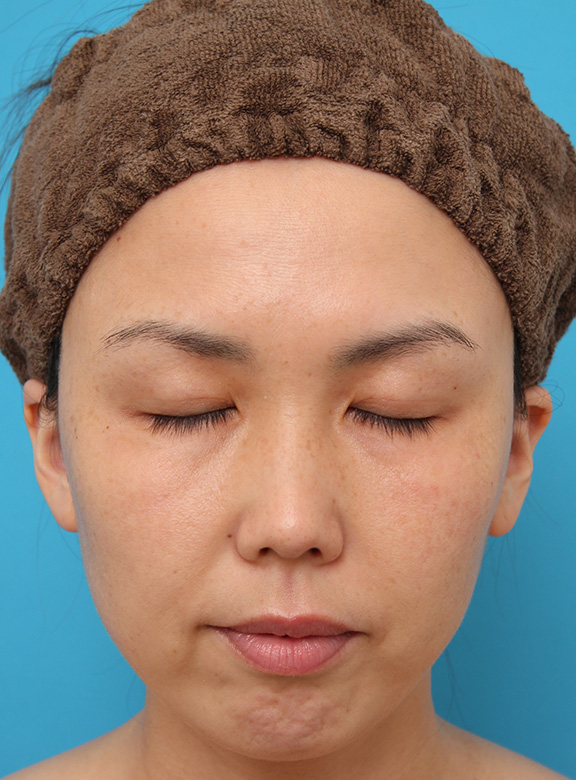 症例写真,二重まぶた埋没法2針固定でたるんでいる皮膚を持ち上げて目を大きくした30代女性の症例写真,After(6ヶ月後),