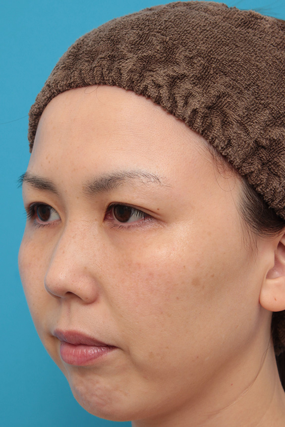 症例写真,二重まぶた埋没法2針固定でたるんでいる皮膚を持ち上げて目を大きくした30代女性の症例写真,After(6ヶ月後),ba_maibotsu036_b02.jpg