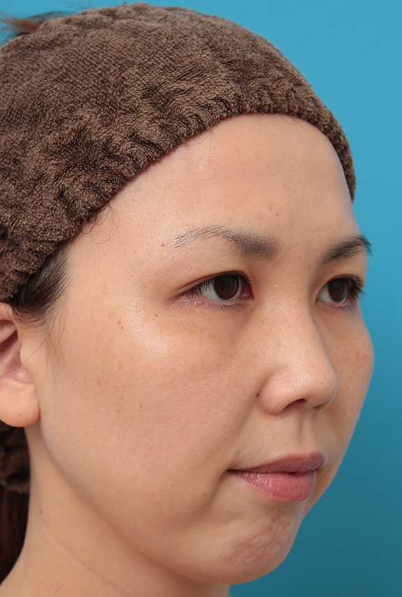 症例写真,二重まぶた埋没法2針固定でたるんでいる皮膚を持ち上げて目を大きくした30代女性の症例写真,After(6ヶ月後),ba_maibotsu036_b03.jpg