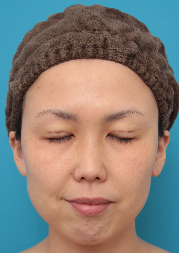 症例写真,二重まぶた埋没法2針固定でたるんでいる皮膚を持ち上げて目を大きくした30代女性の症例写真,手術直後,目を閉じた状態,mainpic_maibotsu036c.jpg