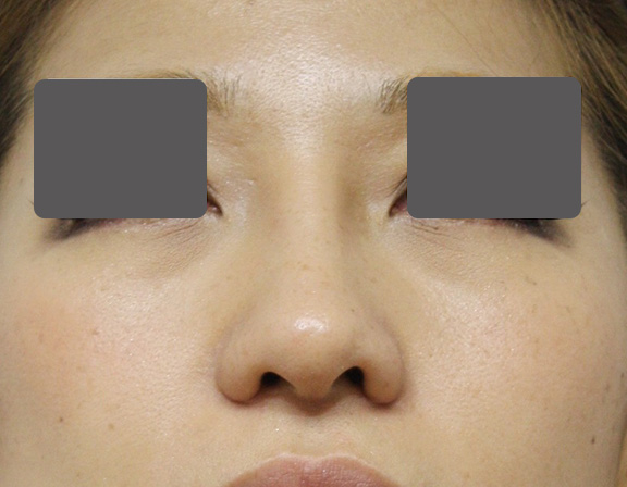 症例写真,5mmの鼻シリコンプロテーゼ+小鼻(鼻翼)縮小手術を行った20代女性の症例写真,After(6ヶ月後),ba_ryubi1037_b02.jpg