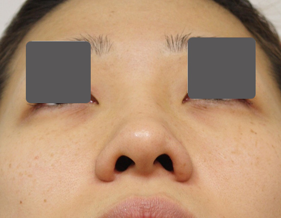 症例写真,5mmの鼻シリコンプロテーゼ+小鼻(鼻翼)縮小手術を行った20代女性の症例写真,Before,ba_ryubi1037_b02.jpg