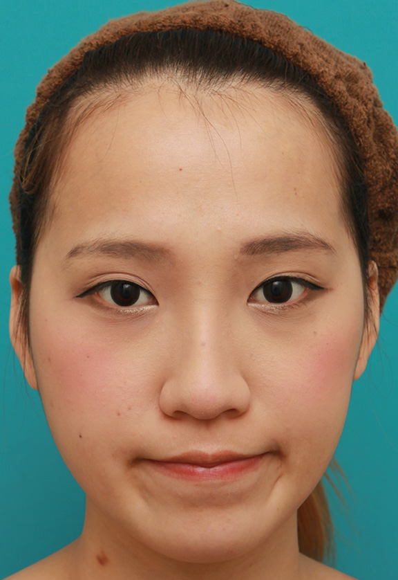 症例写真,鼻に3.5mmの高さのシリコンプロテーゼを入れて、自然に鼻筋を通した症例写真,After(6ヶ月後メイクあり),