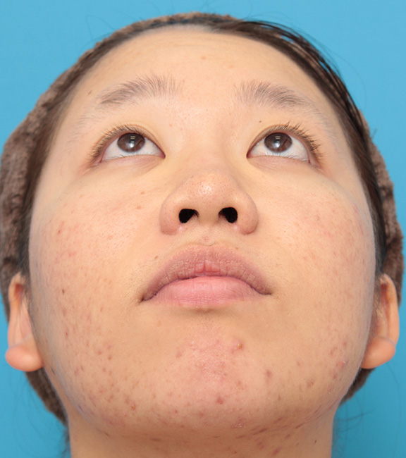 症例写真,小鼻(鼻翼)縮小手術で鼻の穴の内側から外側の途中にかけて切除した症例写真,After(8ヶ月後),ba_biyoku039_b02.jpg