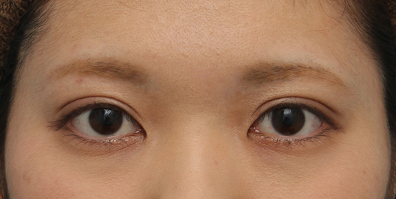 二重まぶた・全切開法,二重まぶた全切開法でやや幅の広い平行型二重を作った症例写真,After(1年3ヶ月後のメイクありの状態),