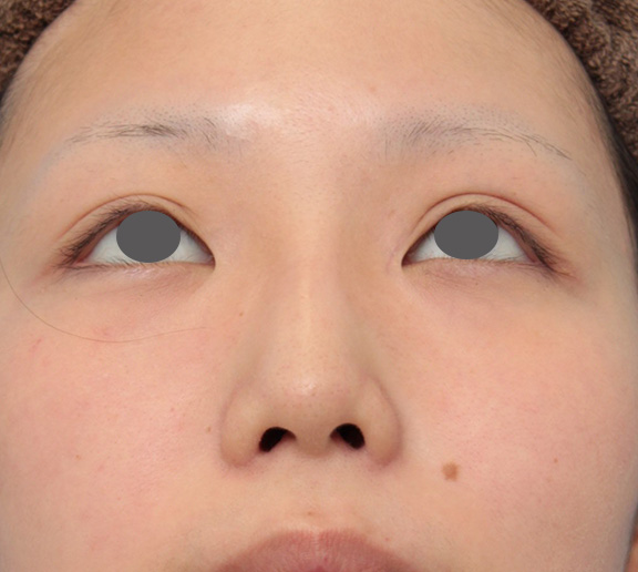 症例写真,鼻のシリコンプロテーゼと小鼻(鼻翼)縮小手術を同時に行った症例写真,After(6ヶ月後),ba_ryubi1039_b02.jpg