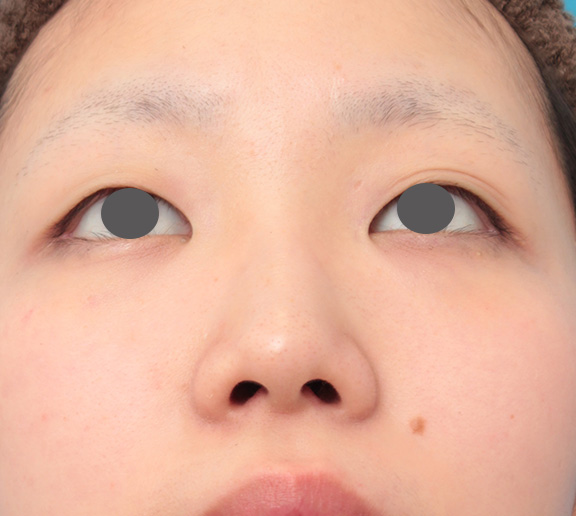 症例写真,鼻のシリコンプロテーゼと小鼻(鼻翼)縮小手術を同時に行った症例写真,Before,ba_ryubi1039_b02.jpg