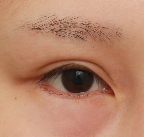 症例写真,下まぶたの逆さまつ毛の修正手術の症例写真,After(6ヶ月後),ba_trichiasis001_b01.jpg