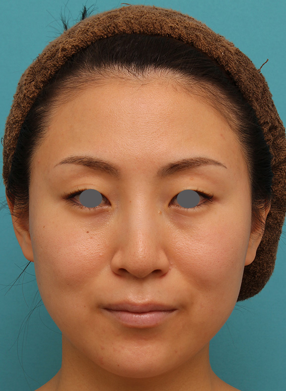 症例写真,下がっている口角を上げるボツリヌストキシン注射の症例写真,After(1ヶ月後),ba_lipsup_botox005_b01.jpg