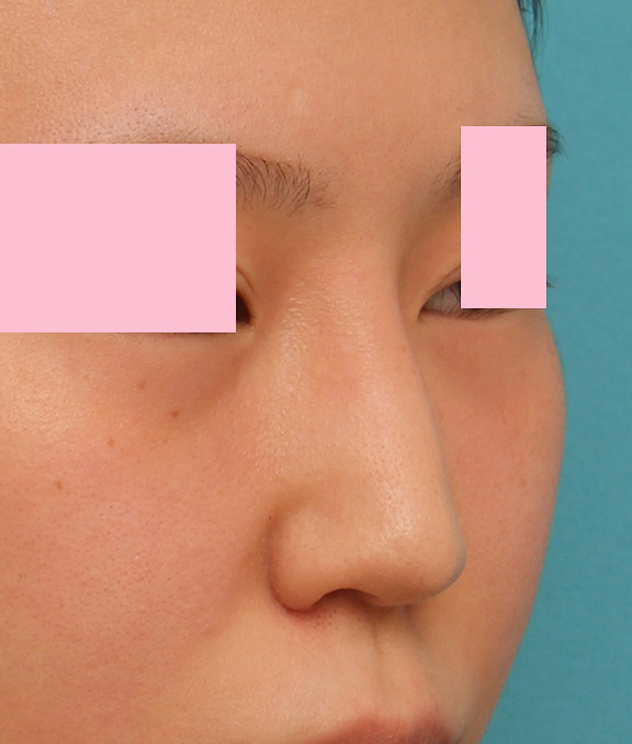 症例写真,小鼻(鼻翼)縮小手術と鼻先の耳介軟骨移植を同時に行った20代女性の症例写真,After,ba_jikai035_b02.jpg