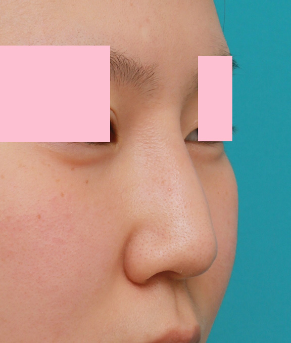 症例写真,小鼻(鼻翼)縮小手術と鼻先の耳介軟骨移植を同時に行った20代女性の症例写真,Before,ba_jikai035_b02.jpg