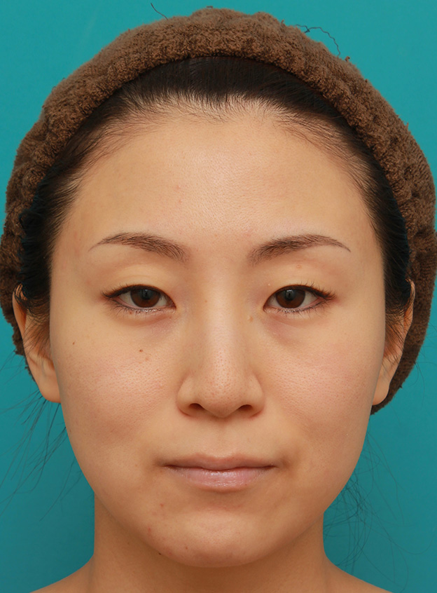 イタリアンリフト,イタリアンリフトを施した30代女性の症例写真,1週間後,mainpic_italian019c.jpg