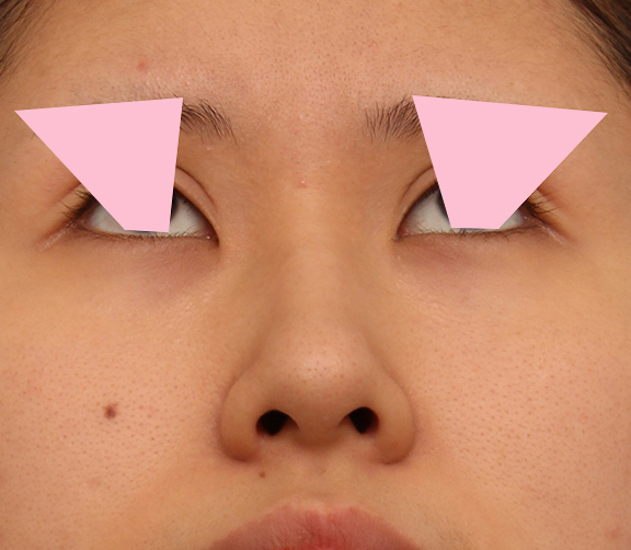 症例写真,鼻の穴の内側から外側の途中にかけて切除するデザインで小鼻縮小した症例写真,After(6ヶ月後),ba_biyoku042_b02.jpg