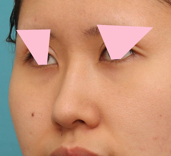 症例写真,鼻の穴の内側から外側の途中にかけて切除するデザインで小鼻縮小した症例写真,After(6ヶ月後),ba_biyoku042_b03.jpg