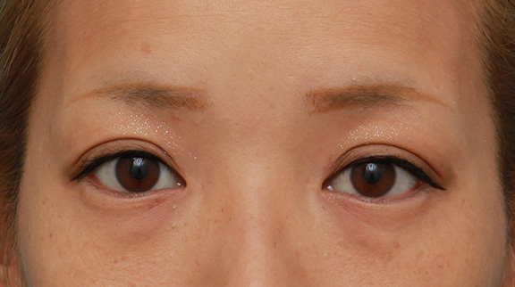 二重まぶた・全切開法,二重まぶた全切開法でやや幅広の平行型二重にした30代女性の症例写真,After(2年後メイクあり),