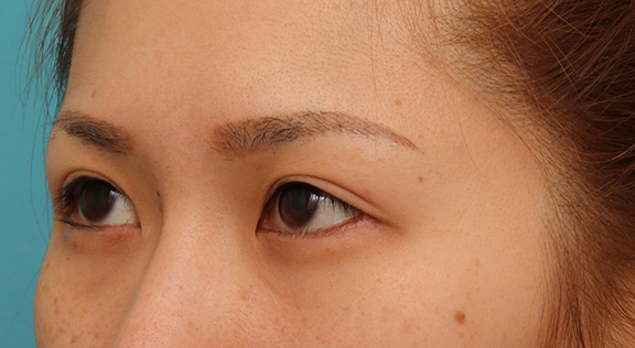 症例写真,目尻切開で目を外側に大きくした20代女性の症例写真,After(6ヶ月後),ba_mejiri015_b02.jpg