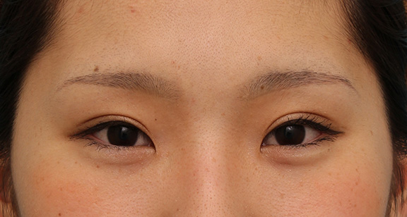 二重まぶた・全切開法,二重まぶた全切開法で、一番自然な幅よりもやや幅を広くして平行型二重にした症例写真,After(6ヶ月後メイクあり),