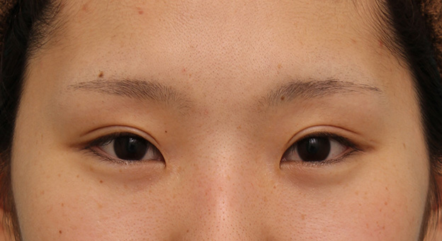 二重まぶた・全切開法,二重まぶた全切開法で、一番自然な幅よりもやや幅を広くして平行型二重にした症例写真,6ヶ月後,メイクなし,mainpic_sekkai051e.jpg