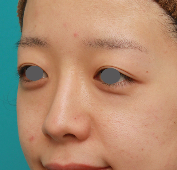 症例写真,鼻シリコンプロテーゼ+鼻先の耳介軟骨移植+小鼻縮小の症例写真,After(7ヶ月後),ba_ryubi1041_b02.jpg