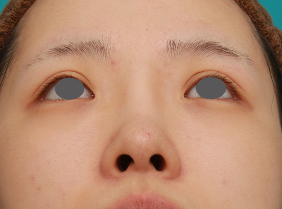 症例写真,のっぺりした平らな顔に3.5mmのI型シリコンプロテーゼを入れ、自然に鼻筋を通した症例写真,After(6ヶ月後),ba_ryubi1042_b04.jpg