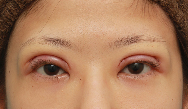 眼瞼下垂（がんけんかすい）,眼瞼下垂（がんけんかすい）の症例写真 眼瞼下垂手術＋二重まぶた全切開法,手術直後,mainpic_ganken035b.jpg