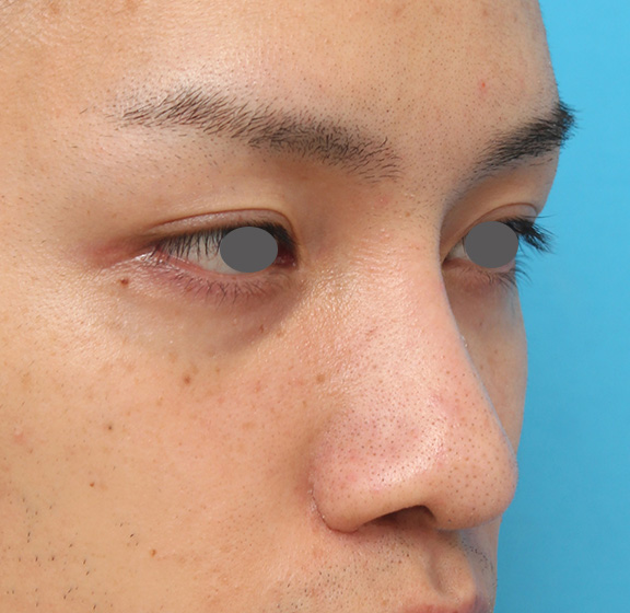症例写真,5mmのI型シリコンプロテーゼを鼻に入れて高くし、鼻筋を通した症例写真,After(6ヶ月後),ba_ryubi1043_b02.jpg