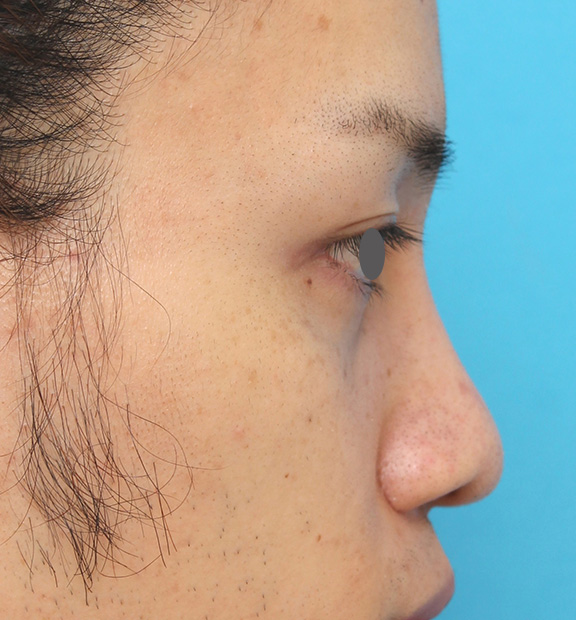 症例写真,5mmのI型シリコンプロテーゼを鼻に入れて高くし、鼻筋を通した症例写真,After(6ヶ月後),ba_ryubi1043_b03.jpg