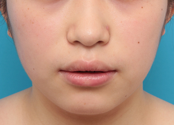 唇を薄く(口唇縮小術),下唇のみを薄くしてバランスを良くした症例写真,After(6ヶ月後),ba_usuku008_b02.jpg