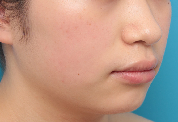 唇を薄く(口唇縮小術),下唇のみを薄くしてバランスを良くした症例写真,After(6ヶ月後),ba_usuku008_b03.jpg