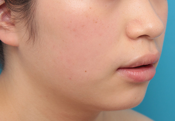 唇を薄く(口唇縮小術),下唇のみを薄くしてバランスを良くした症例写真,After(6ヶ月後),ba_usuku008_b04.jpg