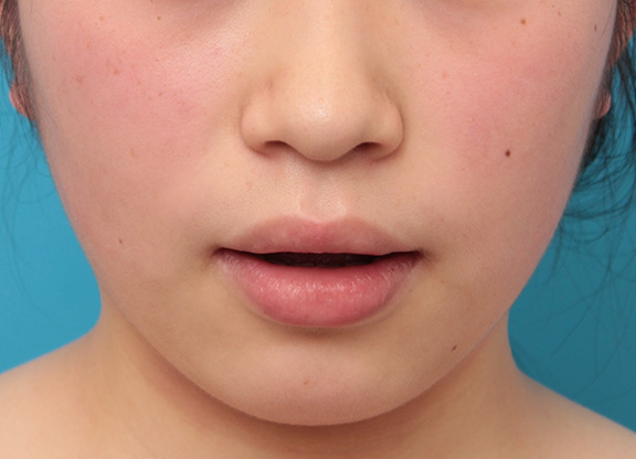 唇を薄く(口唇縮小術),下唇のみを薄くしてバランスを良くした症例写真,Before,ba_usuku008_b02.jpg
