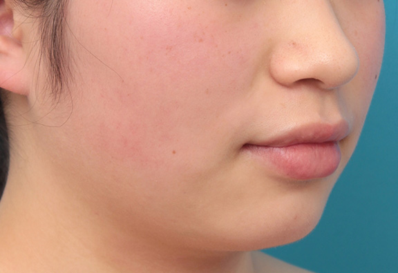 唇を薄く(口唇縮小術),下唇のみを薄くしてバランスを良くした症例写真,Before,ba_usuku008_b03.jpg