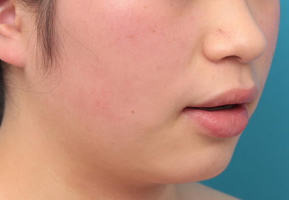 唇を薄く(口唇縮小術),下唇のみを薄くしてバランスを良くした症例写真,Before,ba_usuku008_b04.jpg