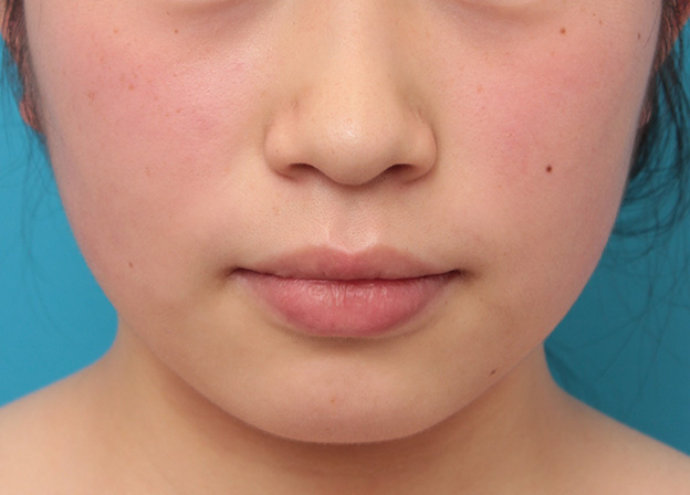 唇を薄く（口唇縮小術）,下唇のみを薄くしてバランスを良くした症例写真,手術前,mainpic_usuku008a.jpg