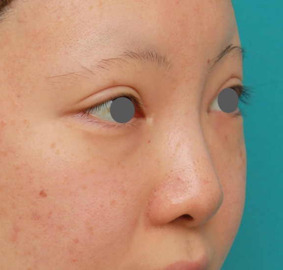 耳介軟骨移植(鼻先を出す),鼻のヒアルロン酸を溶解し、シリコンプロテーゼ+鼻先耳介軟骨移植をした症例写真,Before,ba_ryubi1046_b02.jpg