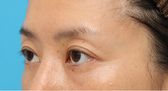 症例写真,目尻切開で目を外側に広げた40代後半の女性の症例写真,After(6ヶ月後),ba_mejiri016_b02.jpg