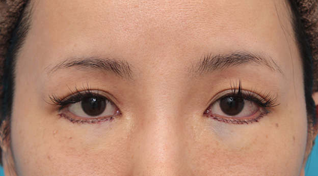 症例写真,下三白眼にタレ目形成（グラマラスライン）を行った症例写真,手術直後,mainpic_panda020b.jpg