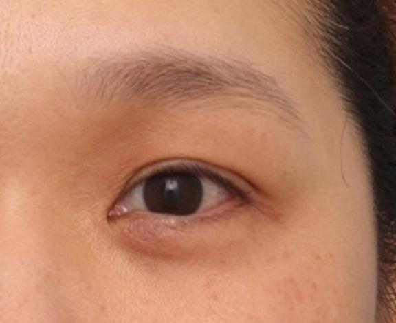 症例写真,分厚い上まぶたに脂肪溶解注射メソシェイプフェイス(上まぶた)をし、薄くした症例写真,After(4回目注射後1ヶ月後),ba_meso_mabuta001_b01.jpg