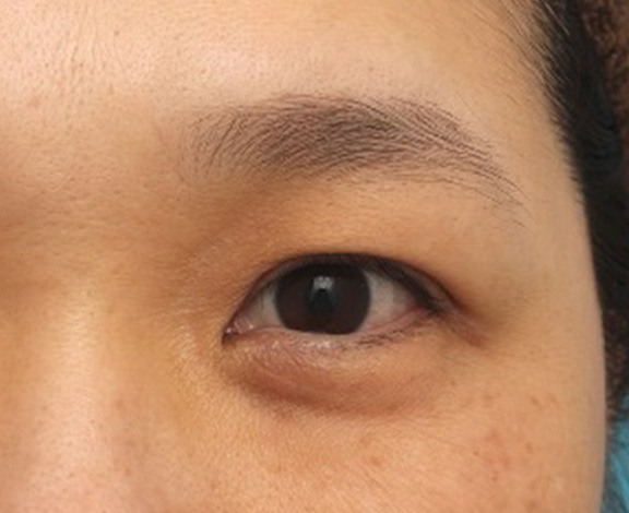 症例写真,分厚い上まぶたに脂肪溶解注射メソシェイプフェイス(上まぶた)をし、薄くした症例写真,Before,ba_meso_mabuta001_b01.jpg
