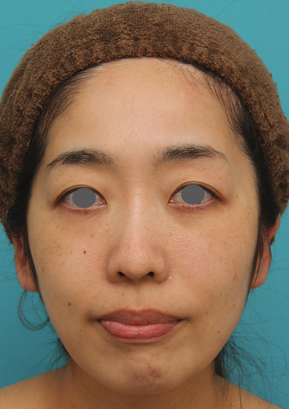 ウルセラシステム,ウルセラシステムでたるみを引き締めて小顔になった30代前半女性の症例写真,After（3ヶ月後）,ba_ulthera020_a01.jpg