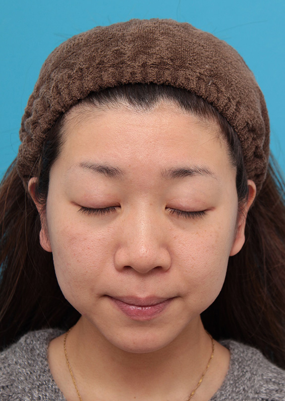 症例写真,二重まぶた・全切開法 もとの二重より少し幅を広げた平行型にした症例,After(6ヶ月後)<br/>
(目を閉じた状態),